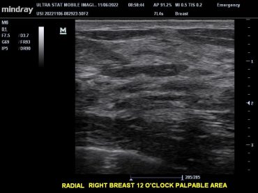 Breast Ultrasound