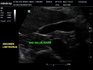 Abdominal Limited/RUQ Ultrasound