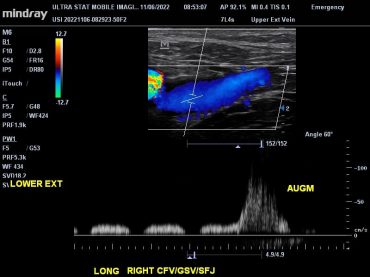 Upper/Lower Extremity Venous Doppler