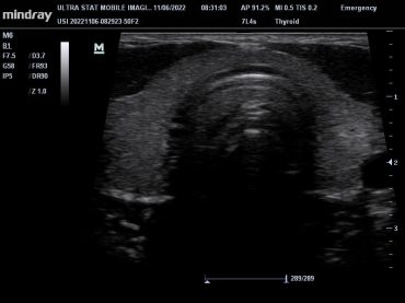 Thyroid Ultrasound