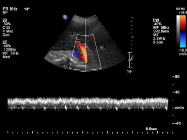 Abdominal Doppler
