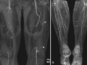 Non Vascular Extremity