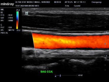 Carotid Doppler