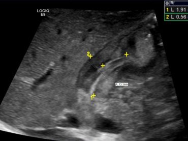 Pyloric Stenosis